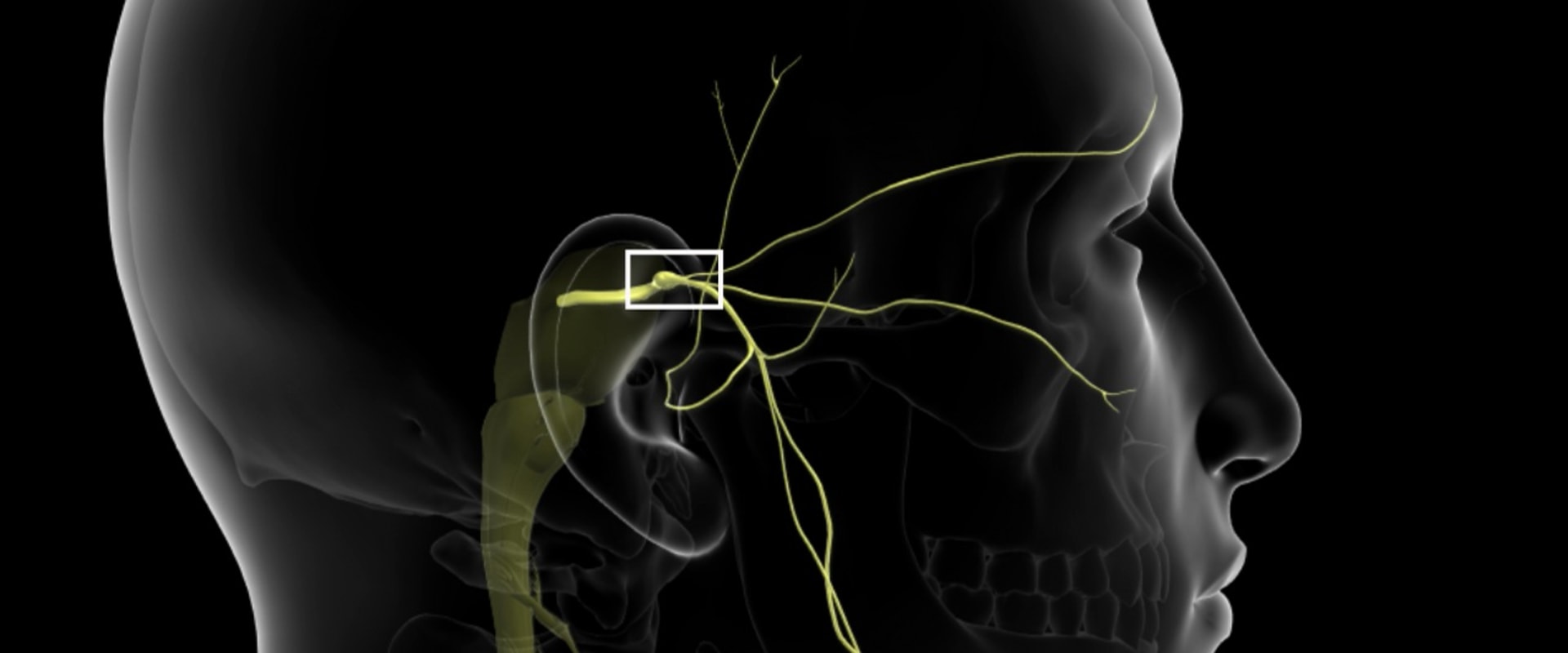 can-facial-fillers-cause-trigeminal-neuralgia