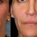 What Happens When Facial Fillers Disappear?