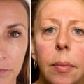 Do Facial Fillers Age You? - A Comprehensive Guide