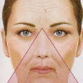 How Long Do Facial Fillers Last? A Comprehensive Guide