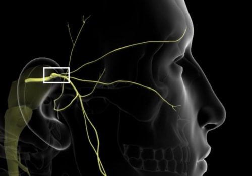 Can Facial Fillers Cause Trigeminal Neuralgia?