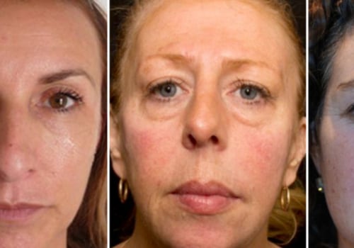 Do Facial Fillers Age You? - A Comprehensive Guide