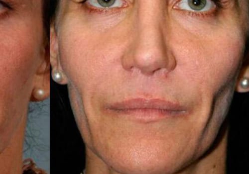 Who Can Help You Achieve Facial Rejuvenation with Dermal Fillers?